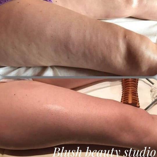 Blush Beauty Studio #beograd Anticelulit masaža Maderoterapija 45 minuta - paket od 10 tretmana