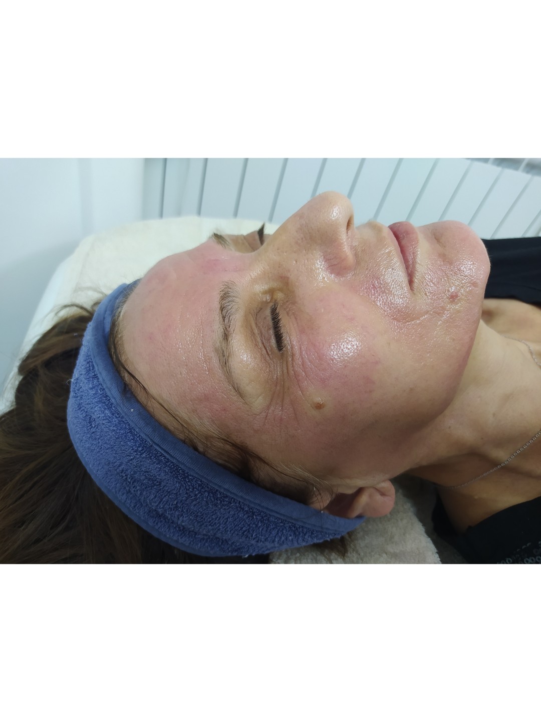 Akademija Stefanović #beograd Tretman lica Dermapen sa FUSION mezoterapijskim koktelima - tretman lica