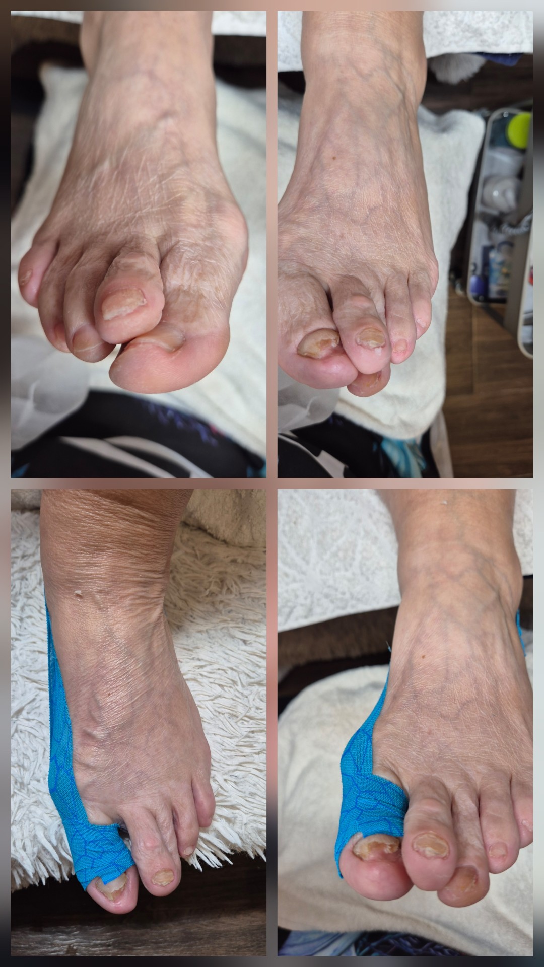 Medicinski pedikir - više problematičan - Bellavana studio, Kruševac Medicinski pedikir Nokti Medicinski pedikir, Kruševac, Centar