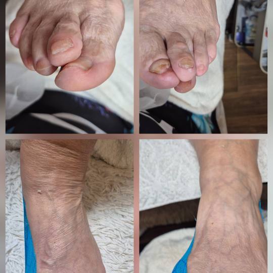 Bellavana studio #krusevac Medicinski pedikir Medicinski pedikir - više problematičan Medicinski p