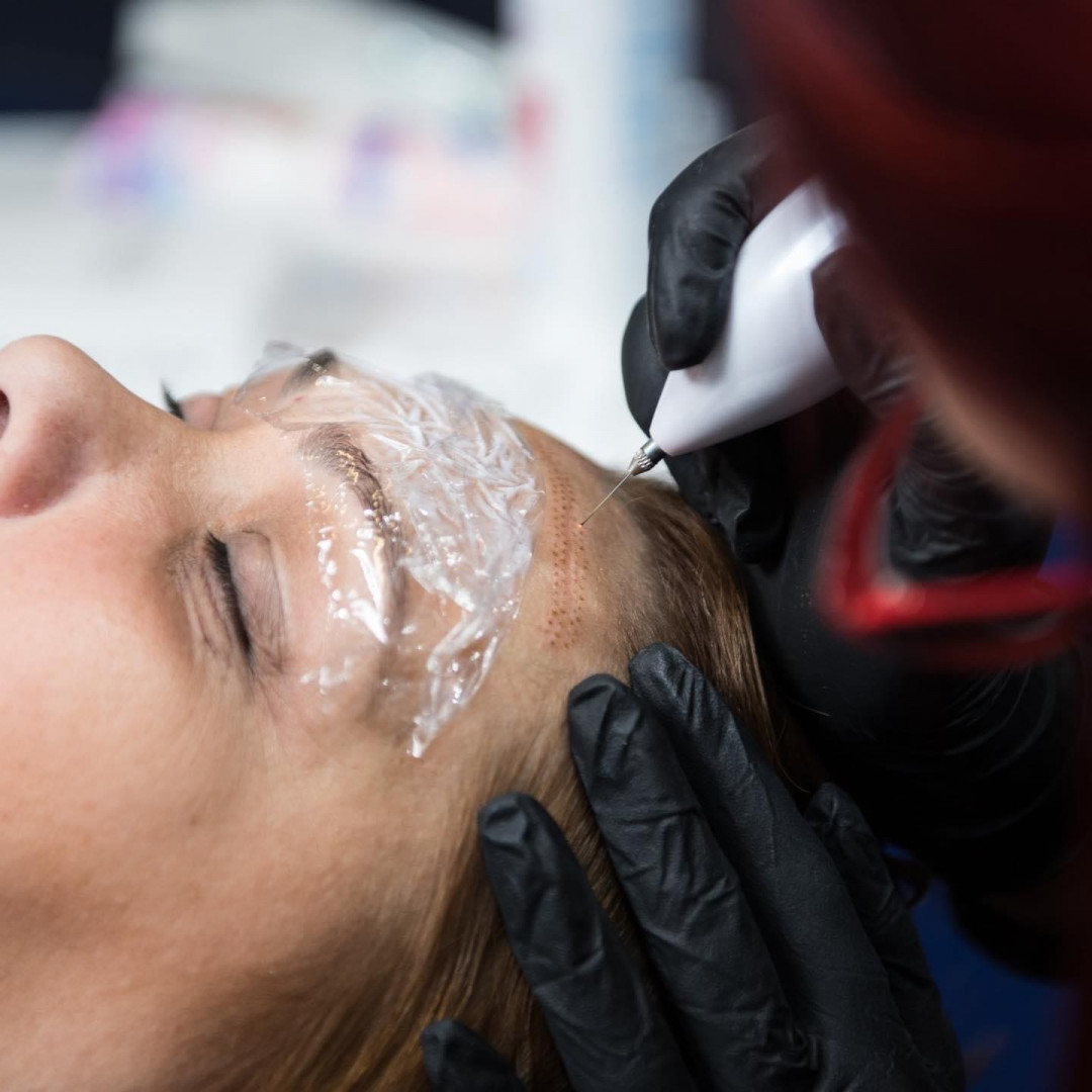 Plasma pen - horizontalne bore čela - Ashanti Beauty Salon & Academy, Beograd Tretman lica Lice Tretman lica, Beograd, Voždovac