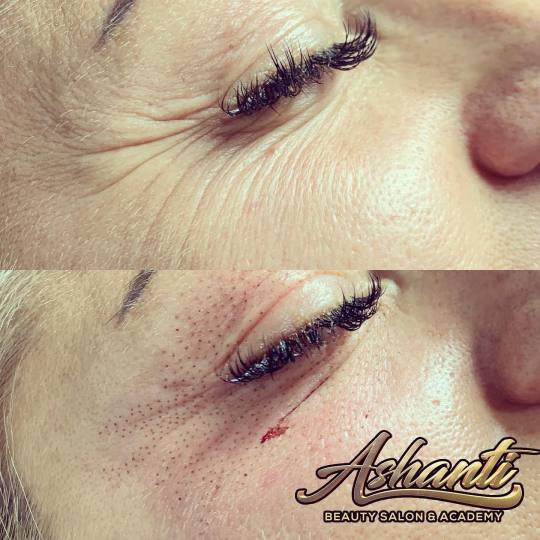 Ashanti Beauty Salon & Academy #beograd Tretman lica Plasma pen - gornji kapci