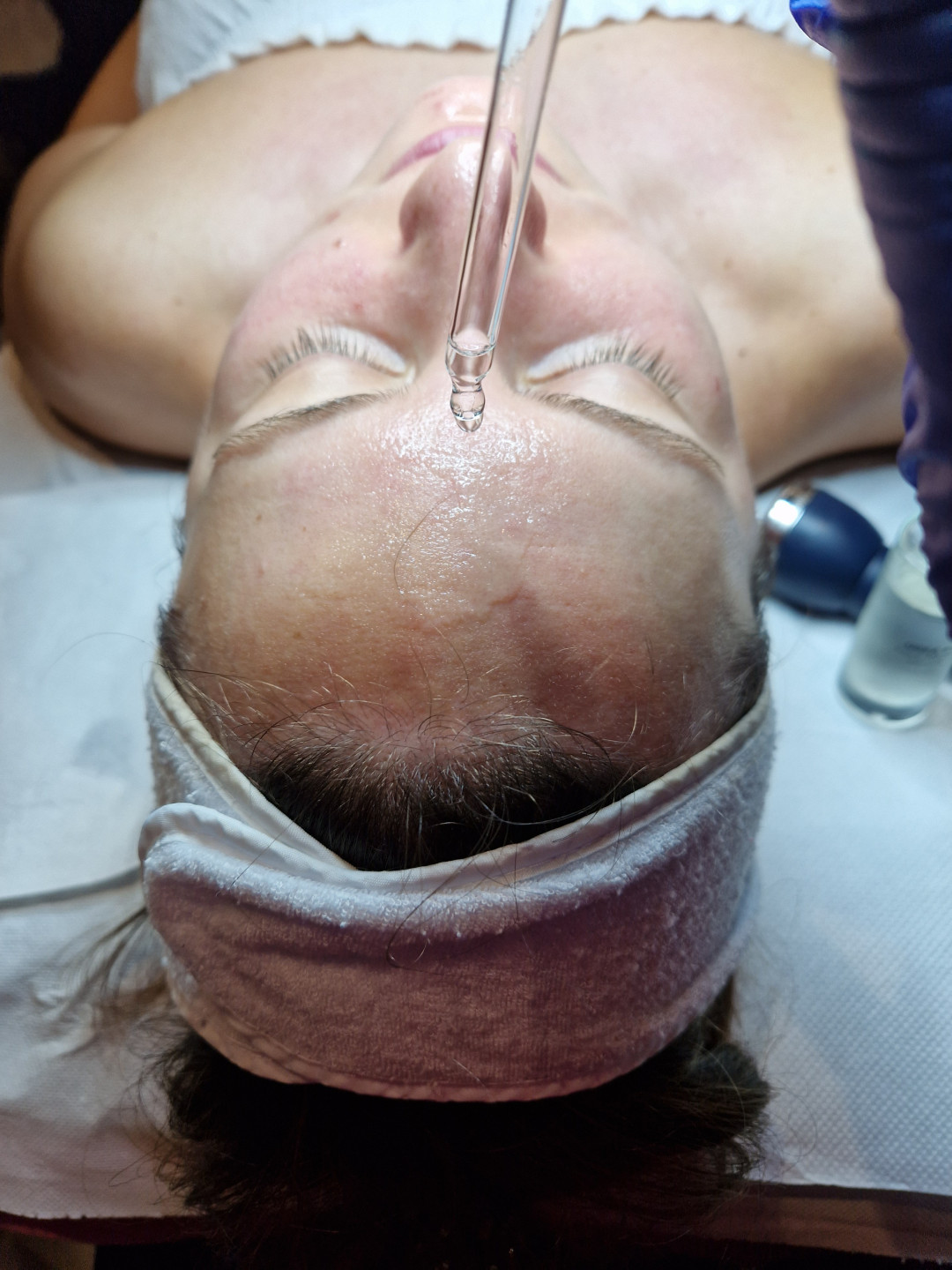 Starmedic #beograd Tretman lica Mezoporacija lica