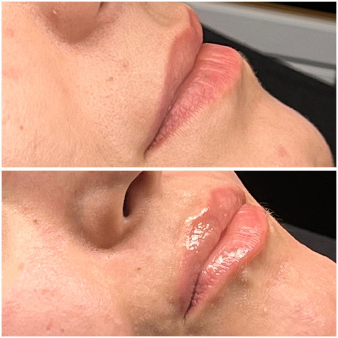 Belle Ana #beograd Tretman lica Microneedling tretman - lice