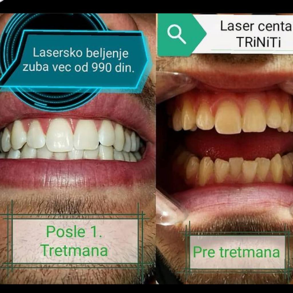 Laser centar Triniti Novi Sad #novisad Zubi Lasersko izbeljivanje zuba - 3 tretmana
