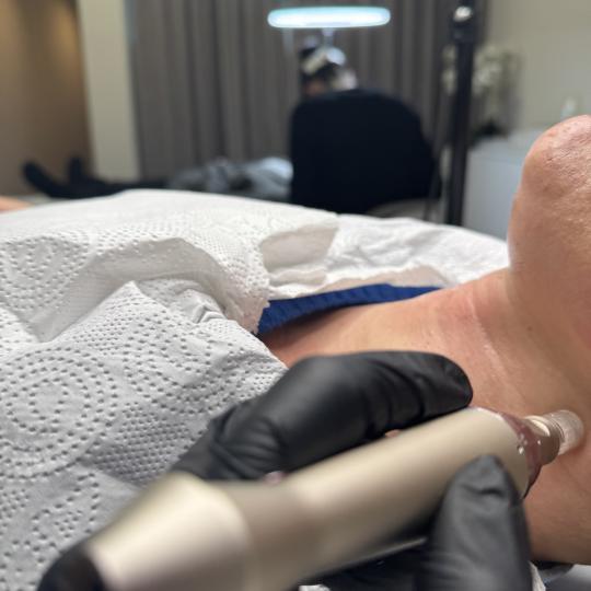 L’Avenue #beograd Mezoterapija lica Dermapen