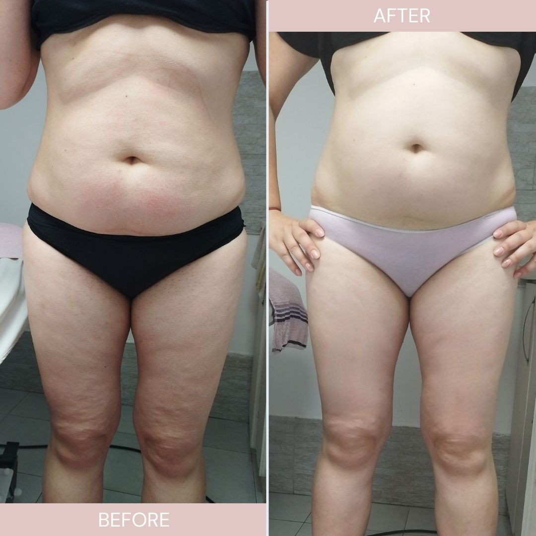 Beauty in Style DM #novisad Kavitacija Kavitacija - po regiji