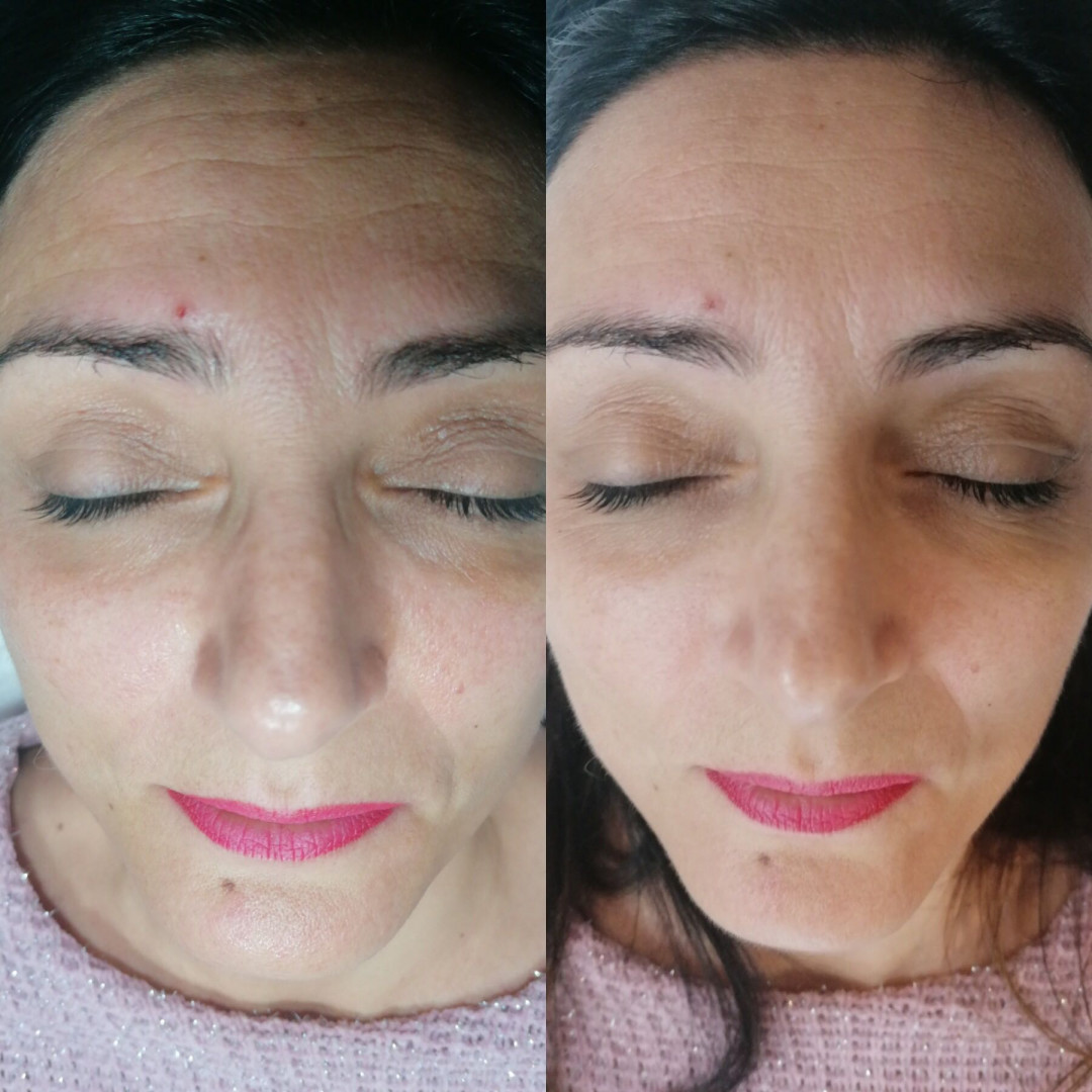Star Dermacare Studio #beograd Tretmani protiv bora