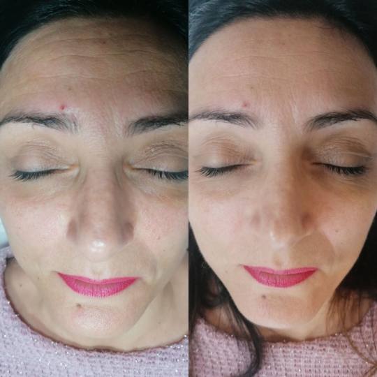 Star Dermacare Studio #beograd Tretmani protiv bora T35P hemijski piling je  idealan za svaki tip ko