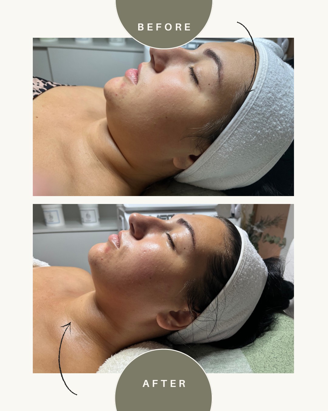Iva Beauty Lab 2 #beograd Tretman lica BASIC PAKET (OSNOVNI TRETMAN) FACELIFTING LICA