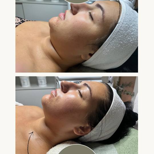 Iva Beauty Lab 2 #beograd Tretman lica BASIC PAKET (OSNOVNI TRETMAN) FACELIFTING LICA Face fitness t
