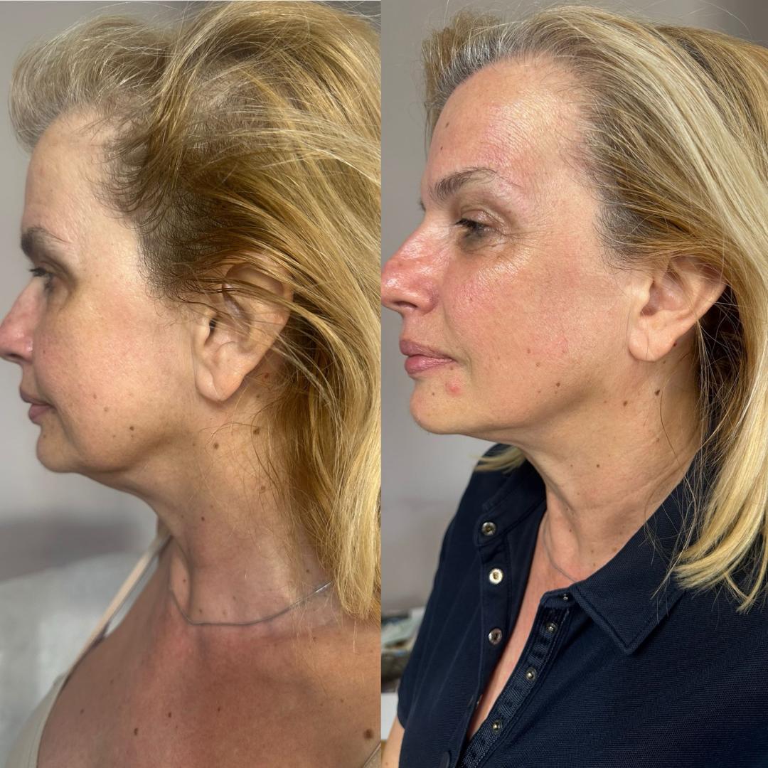 Masaža lica - face lifting - Amelie touch beauty, Beograd Masaža lica Lice Masaža lica, Beograd, Vračar, Čubura, Crveni krst