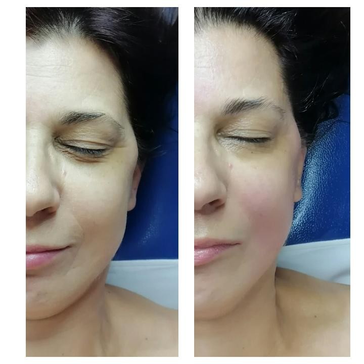 Paris Royal #novisad Tretman lica Miracle face(antiage masaža)
