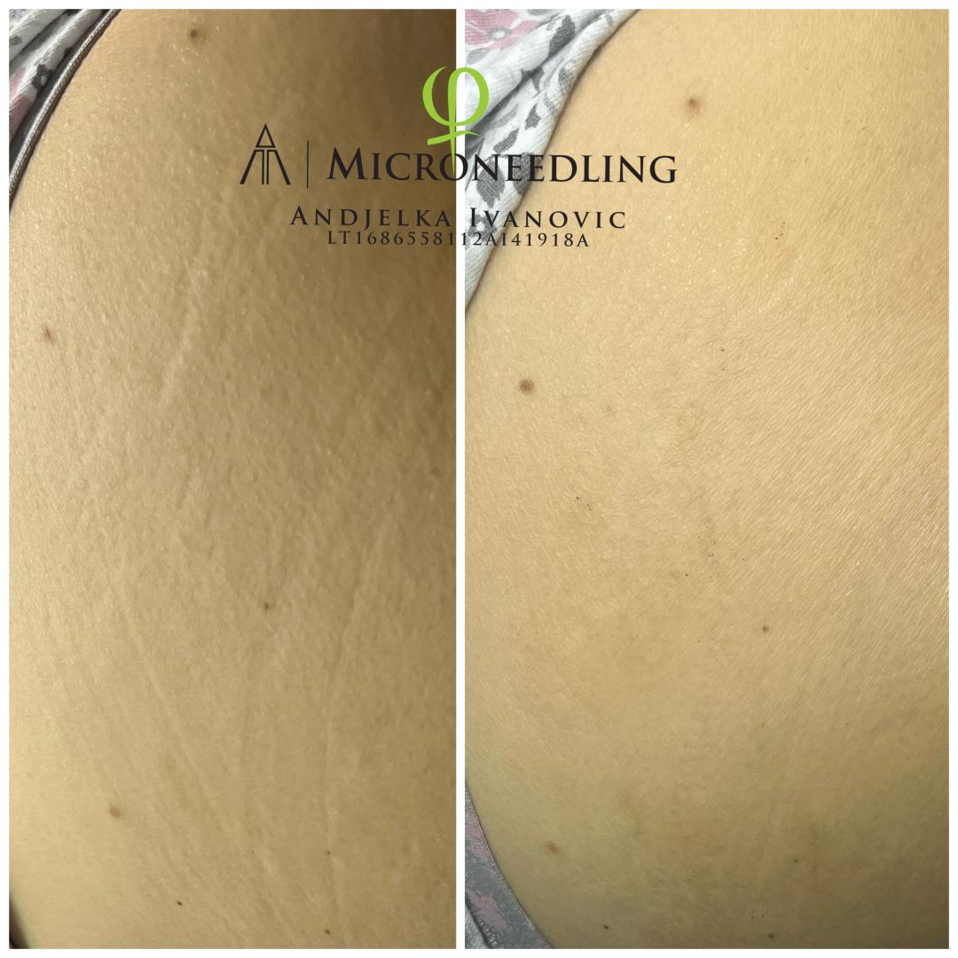 Belle Ana #beograd Odstranjivanje strija Phi-Ion tretman - strije