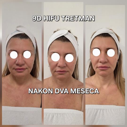 Beauty Vreme za mene #novisad Tretman lica 9D HIFU lice + podbradak
