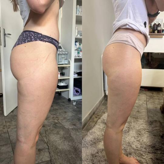 Mila Beauty Centar #beograd Anticelulit masaža Anticelulit ručna masaža Veoma često se susrećem