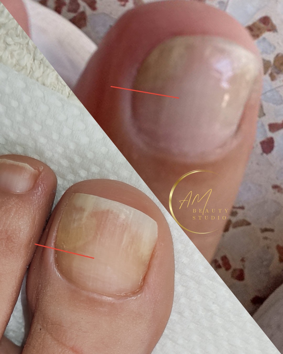 Lasersko uklanjanje gljivica na noktima - obe noge - AM BEAUTY STUDIO, Odžaci Gljivice na noktima Nokti Gljivice na noktima, Odžaci, Centar