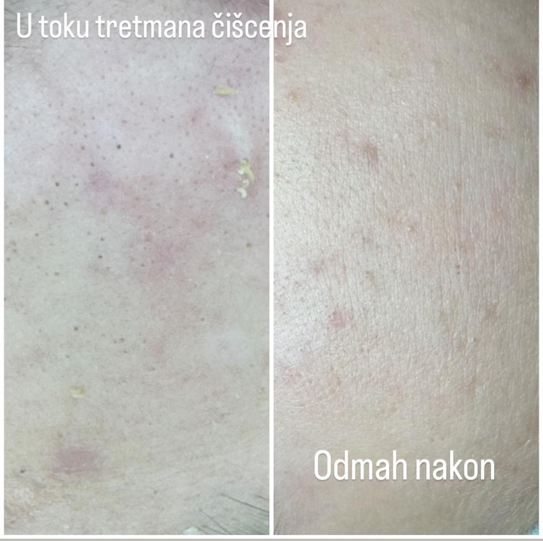 Mladalački tretman čišćenja lica - Petra beauty concept, Beograd Tretman lica Lice Tretman lica, Beograd, Vračar, Čubura, Crveni krst