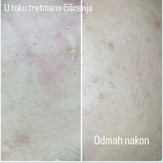 Petra beauty concept #beograd Tretman lica Mladalački tretman čišćenja lica