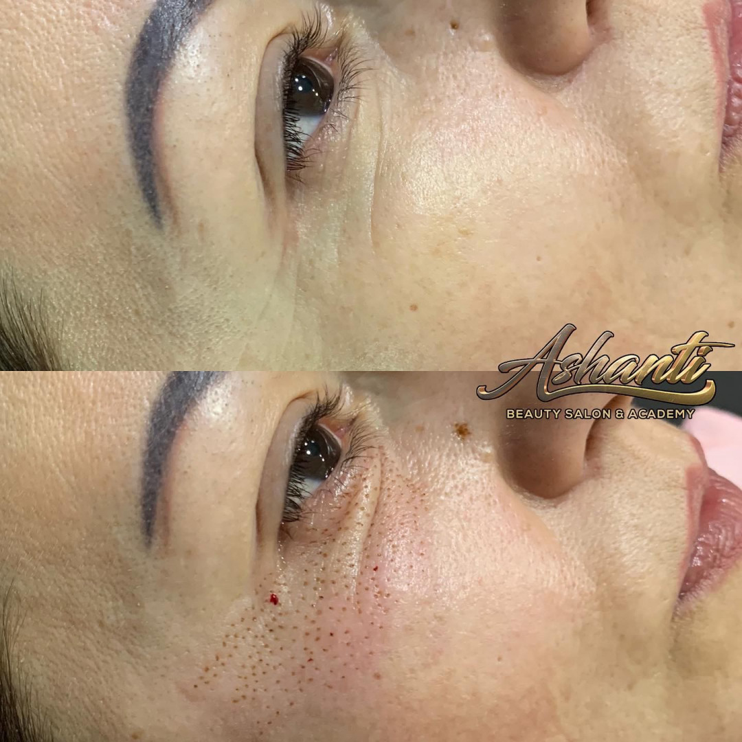 Plasma pen - podočnjaci - Ashanti Beauty Salon & Academy, Beograd Tretman lica Lice Tretman lica, Beograd, Voždovac