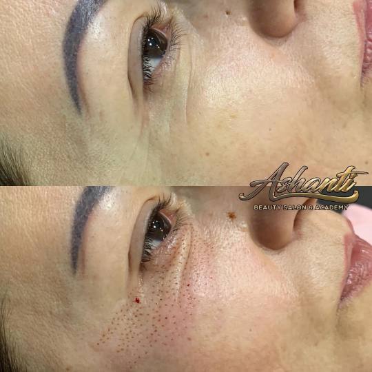 Ashanti Beauty Salon & Academy #beograd Tretman lica Plasma pen - podočnjaci