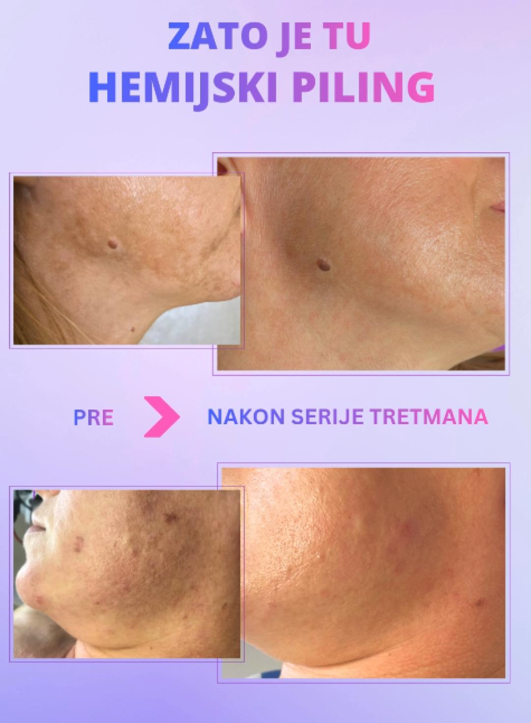 Hemijski piling za hiperpigmentacije - Beauty in Style DM, Novi Sad Tretman lica Lice Tretman lica, Novi Sad, Sajmište, Detelinara, Banatić