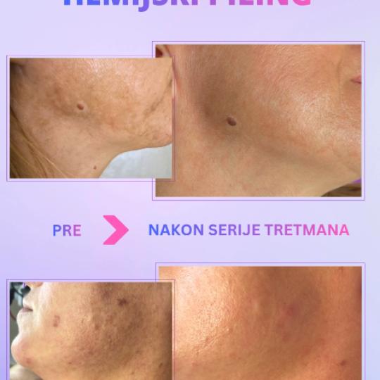 Beauty in Style DM #novisad Tretman lica Hemijski piling za hiperpigmentacije Fleke od sunca, akni i