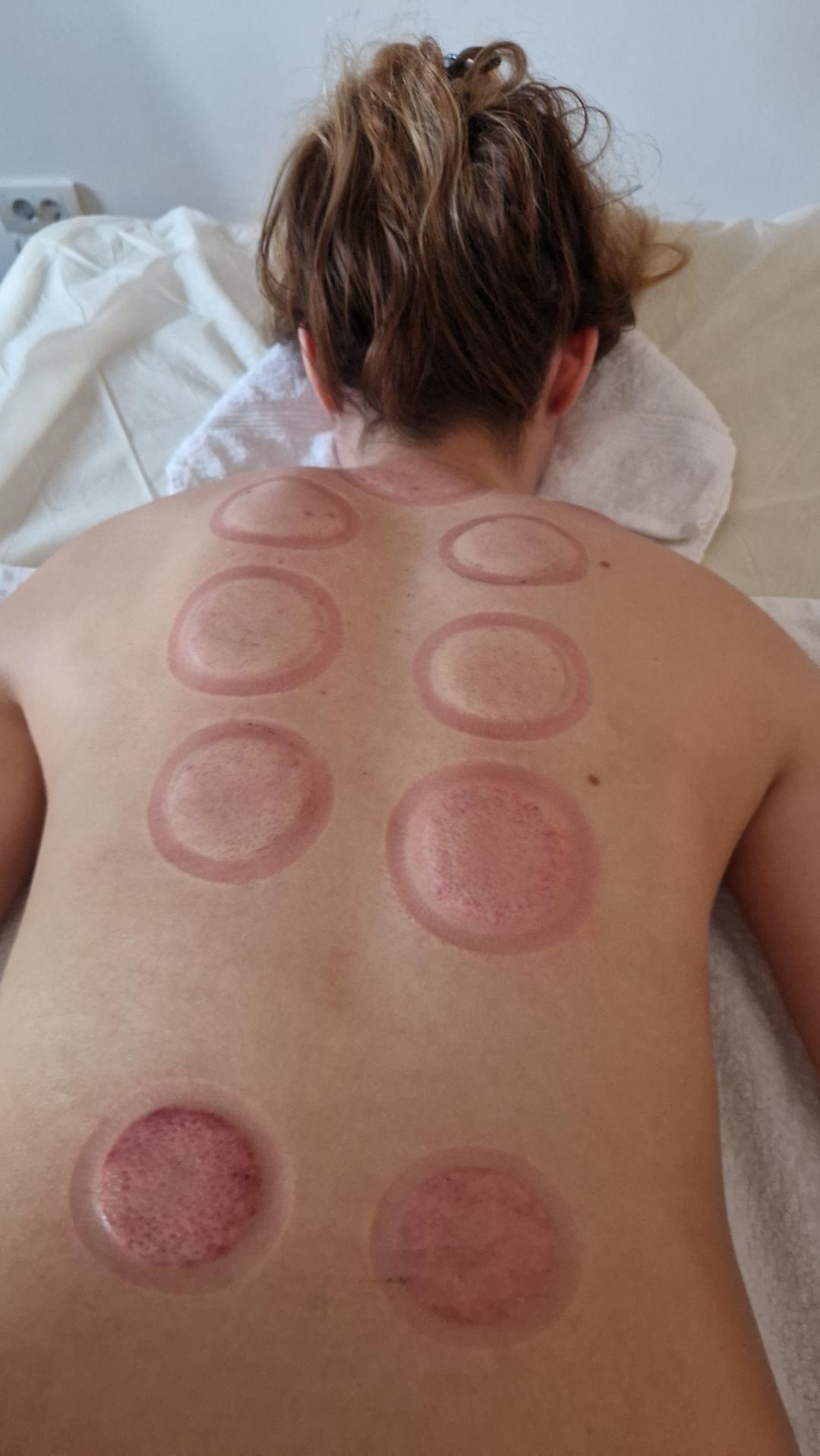 Glow Holistic Studio #beograd Anticelulit Cupping tretman - ventuze 60 min
