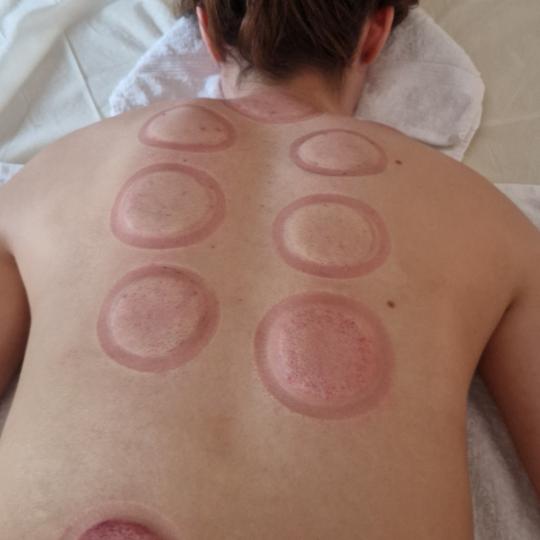 Glow Holistic Studio #beograd Anticelulit Cupping tretman - ventuze 60 min Cupping masaža - terapij