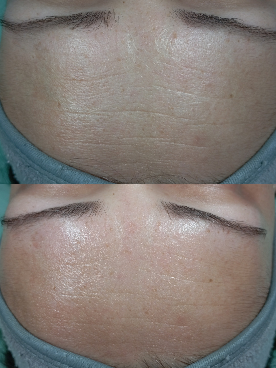 Factor Estetic #beograd Tretman lica Biorevitalizacija lica
