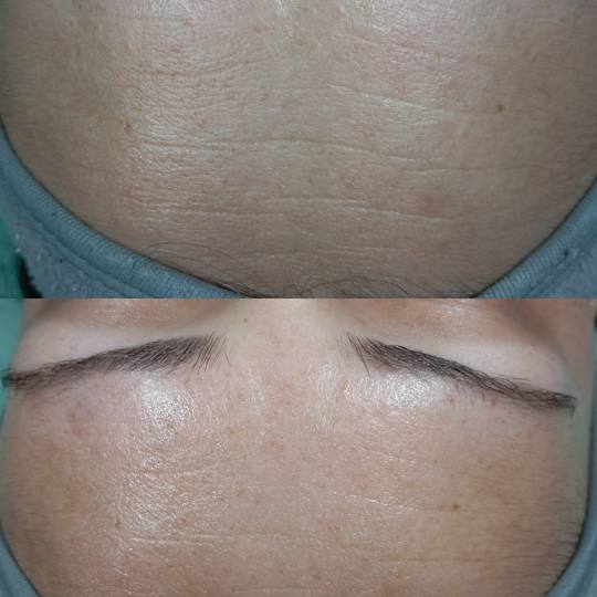 Factor Estetic #beograd Tretman lica Biorevitalizacija lica