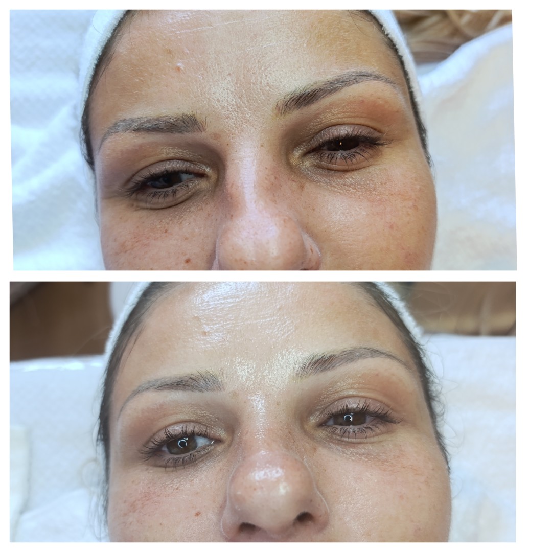 Oladoria Rituals #novisad Tretman lica Hydrafacial + radiotalasni lifting lica