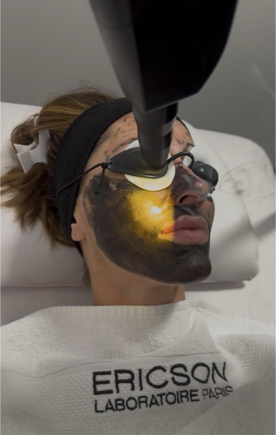 Elevent #beograd Tretman lica Laserski karbon piling lica - holivudski ten