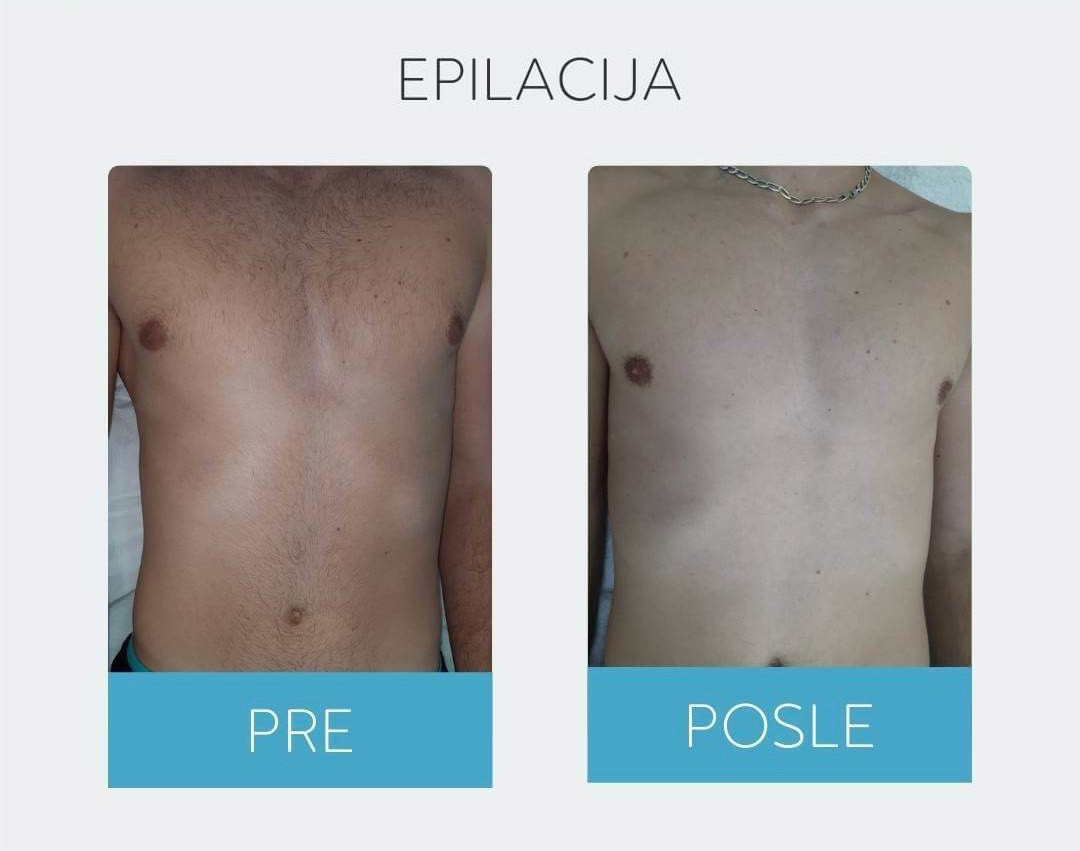 DepilConcept #beograd