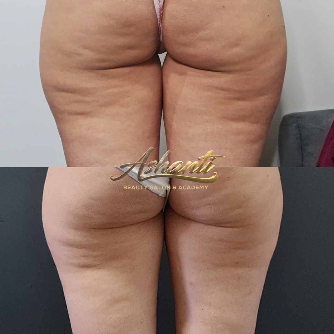 Ashanti Beauty Salon & Academy #beograd Kavitacija Ultrazvučna kavitacija / radiotalasni lifting po regiji - paket od 10 tretmana