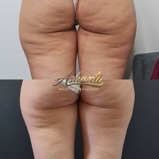 Ashanti Beauty Salon & Academy #beograd Kavitacija Ultrazvučna kavitacija / radiotalasni lifting po