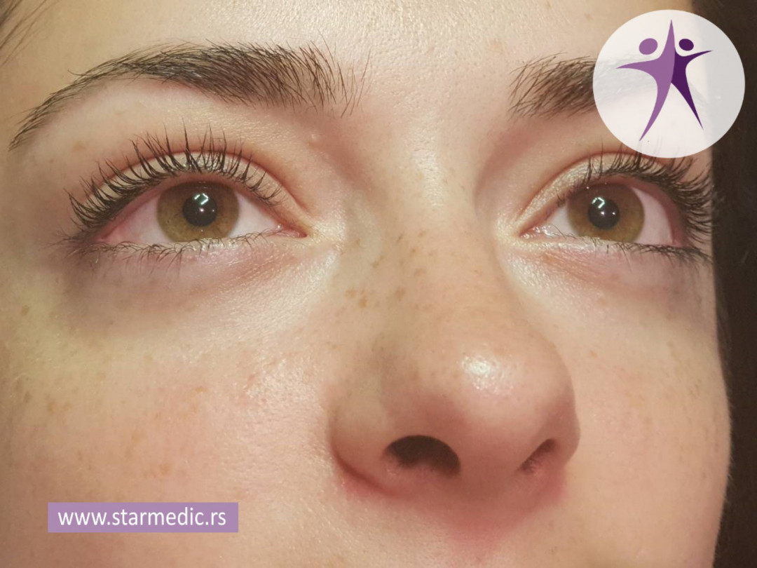 Starmedic #beograd Trepavice Minival trepavica