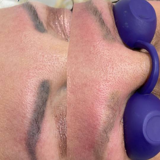Revive - Skin & ink #beograd Trajna šminka Lasersko uklanjanje obrva - 1 tretman nakon 1 laserskog 