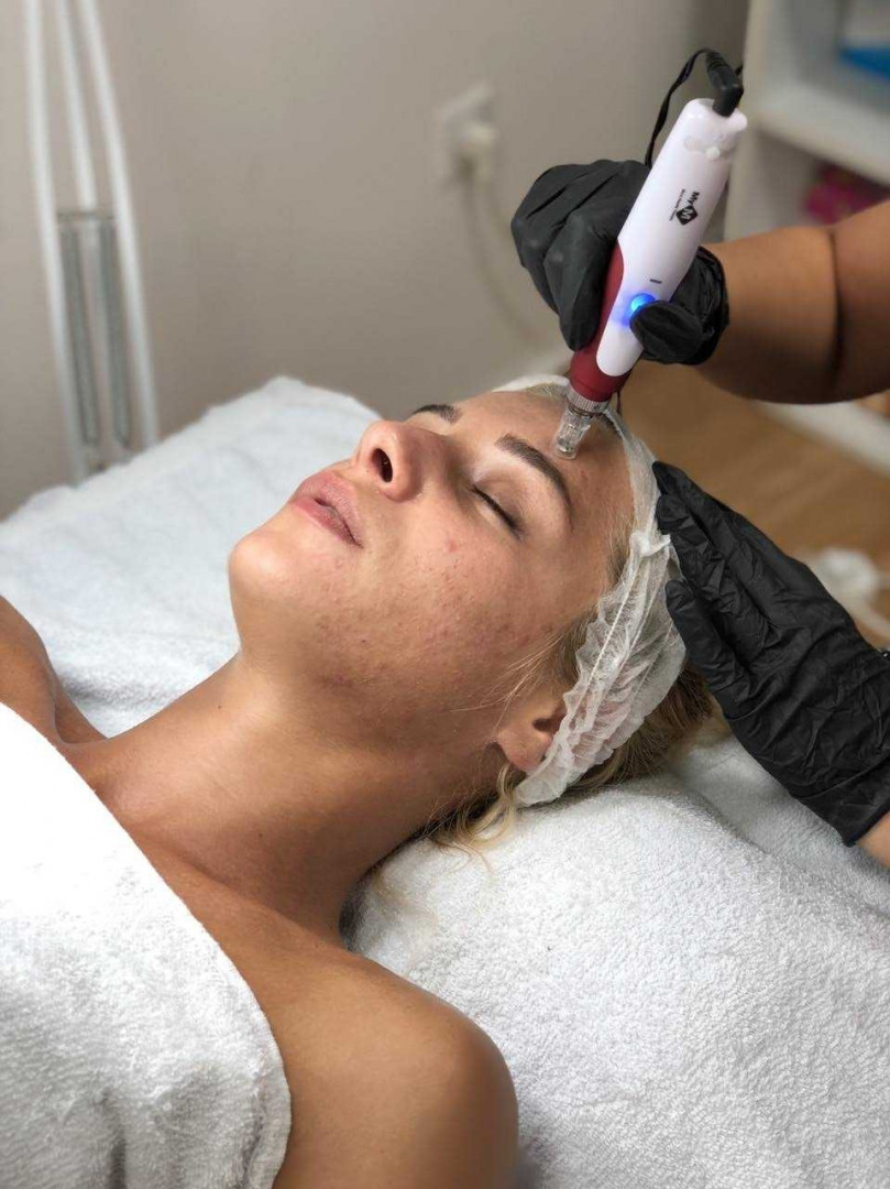 Estetic studio Ognjanović #beograd Tretman lica Dermapen tretman lica