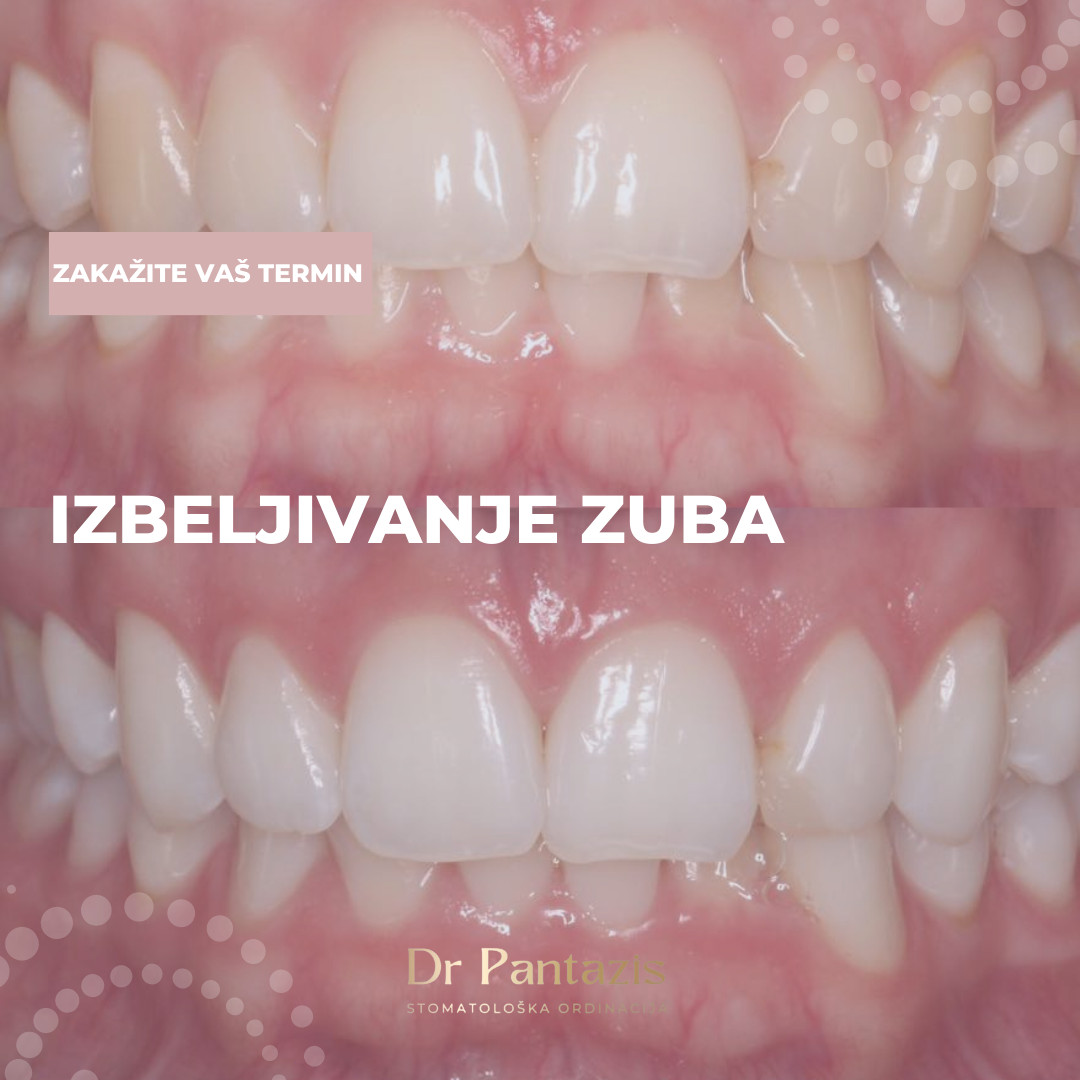 Dr Pantazis - Dental & Beauty Clinic #beograd Zubi Lasersko Profesionalno Izbeljivanje Zuba