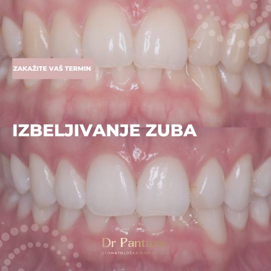 Dr Pantazis - Dental & Beauty Clinic #beograd Zubi Lasersko Profesionalno Izbeljivanje Zuba