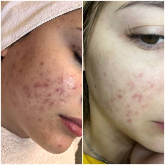 Iva Beauty Lab 2 #beograd Tretman lica Higijenski tretman lica + FITOPILING
