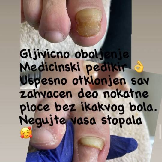 Milica Pavlović Beauty House #beograd Medicinski pedikir Medicinski ruski pedikir - više problemat