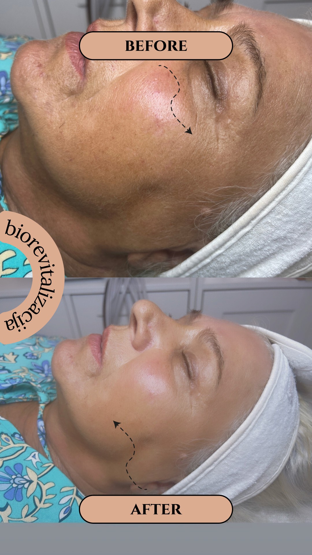 Step up beauty #beograd Tretman lica Biorevitalizacija lica - hemijski piling+ mezokoktel