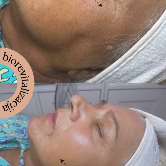 Step up beauty #beograd Tretman lica Biorevitalizacija lica - hemijski piling+ mezokoktel