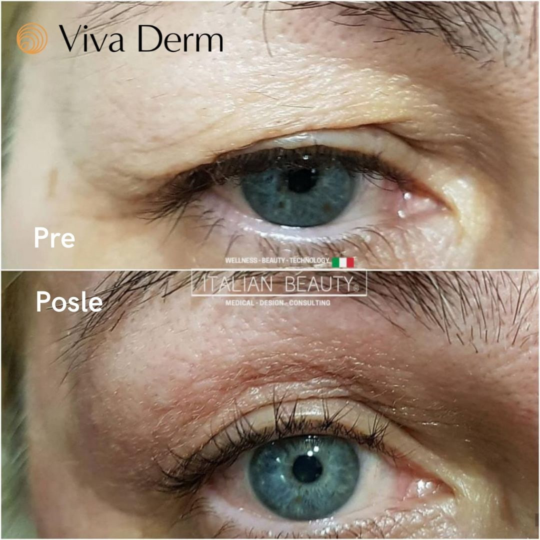 Viva Derm #beograd Tretman lica Tesla MED - Blefarokil (podizanje kapaka)