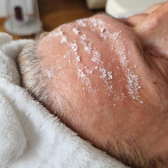 Glow Holistic Studio #beograd Dermaroler i dermapen Dermapen - lice + vrat + dekolte Sa dermapen apa