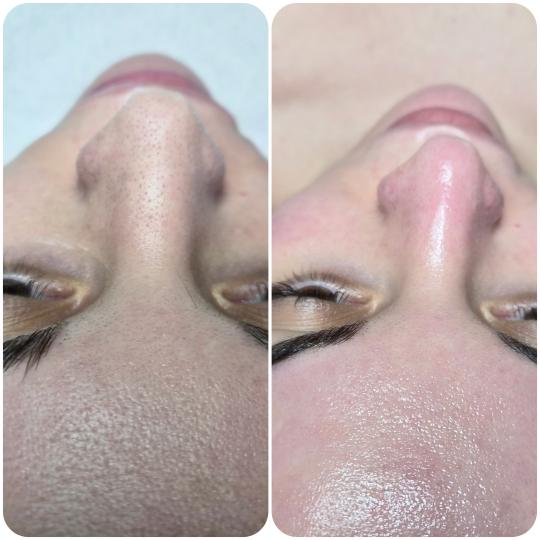 Oladoria Rituals #novisad Tretman lica Higijenski tretman lica Pre i posle higjenskog tretmana lica