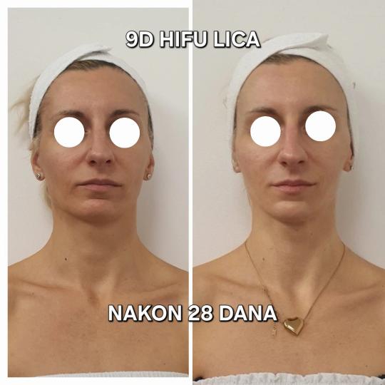 Beauty Vreme za mene #novisad Mikrodermoabrazija Hidralift HIFU tretman+Oxygen tretman Mikrodermoabr