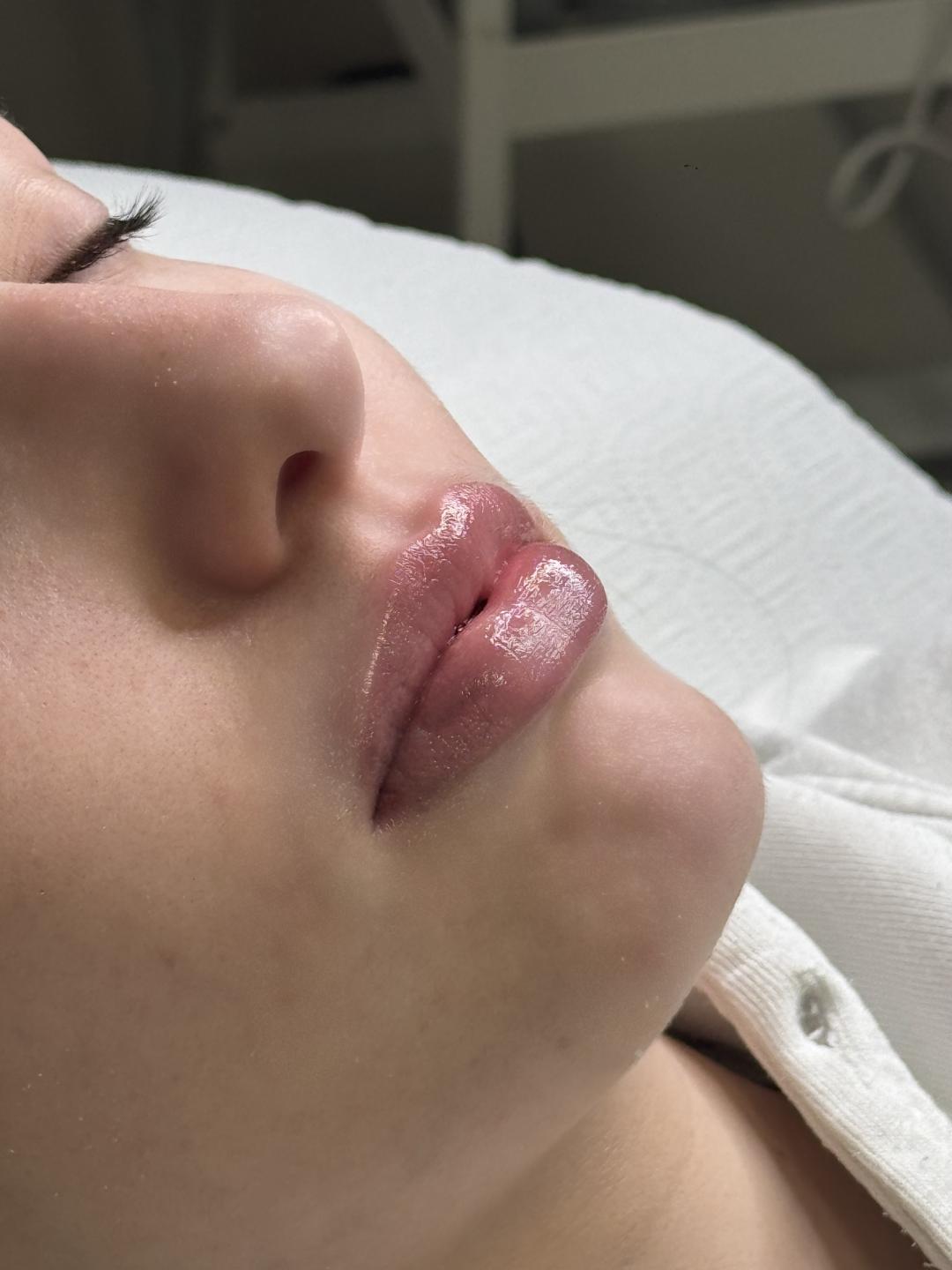 Hydralips-mezoterapija usana hijaluronom - L’Avenue, Beograd Mezoterapija lica Lice Mezoterapija lica, Beograd, Centar, Stari grad, Dorćol